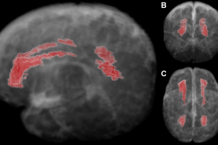 Neonatologist Nehal Parikh and his team developed a software tool for MRIs that predicts motor development disorders in preterm babies.