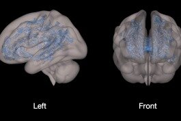 This image from the screen time study is measuring fractional anisotropy, shown in blue, of the white matter in a child that has higher screen time. 